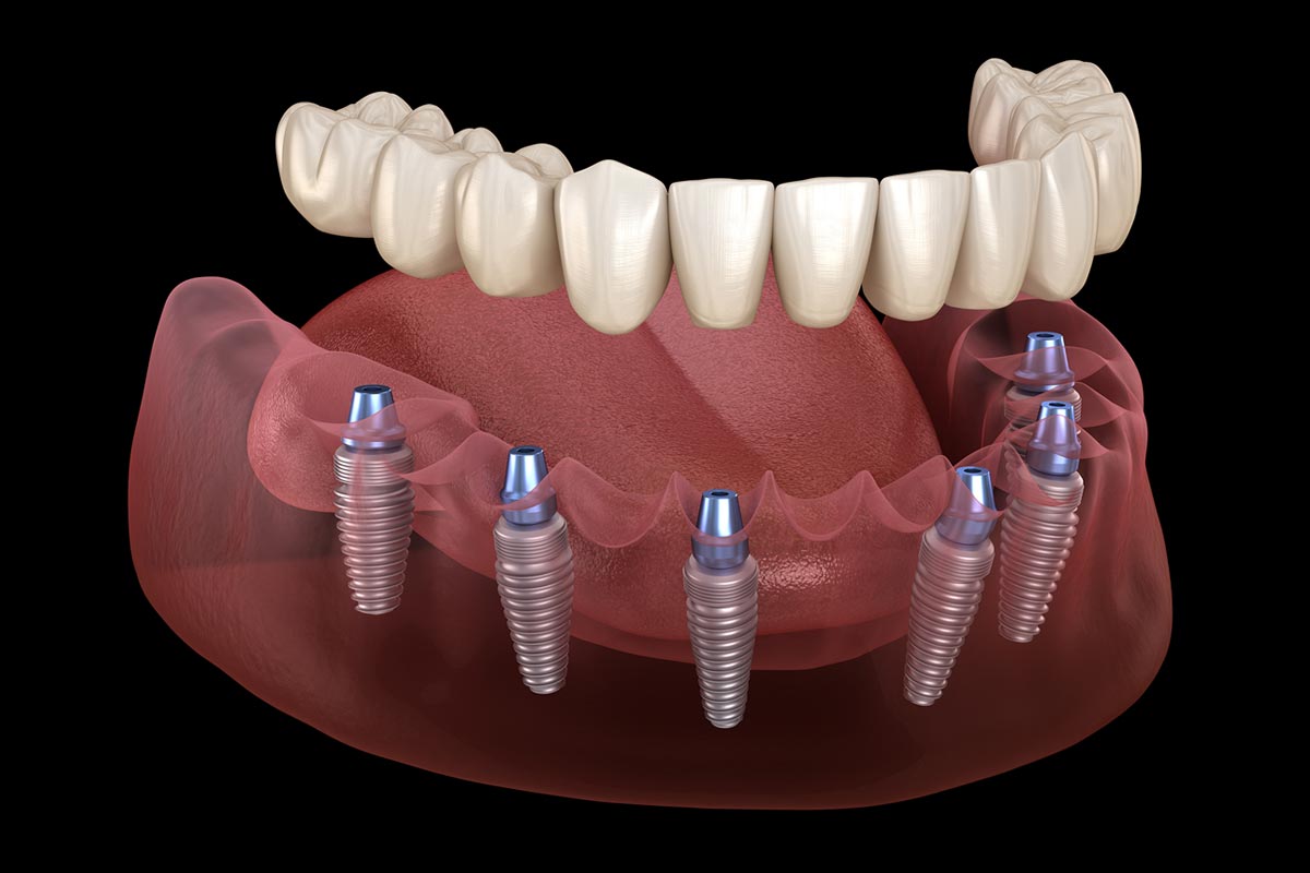 Dental Implants in Burslem