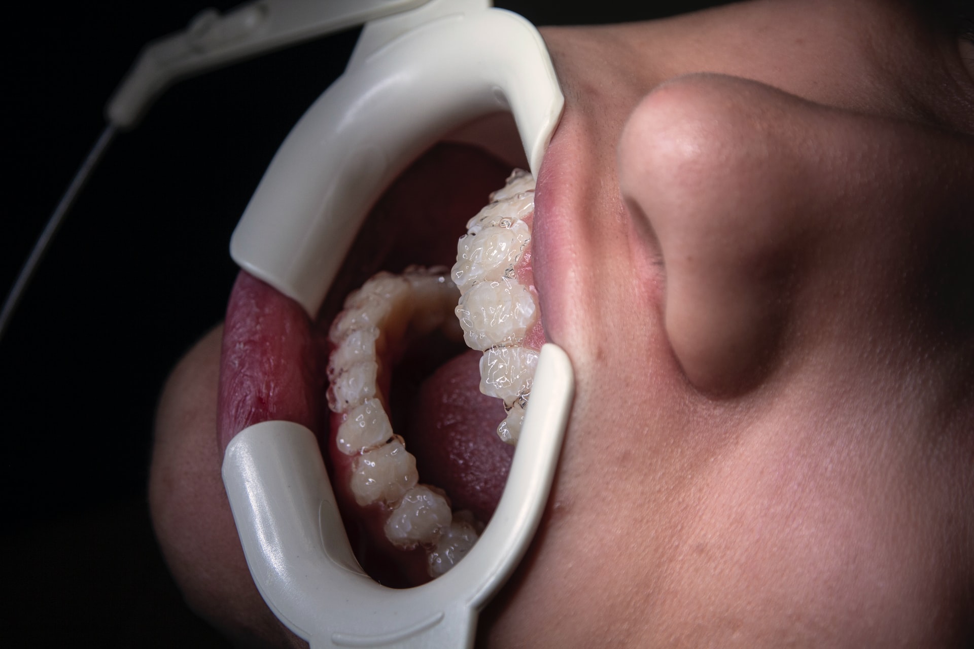 teeth whitening treatment