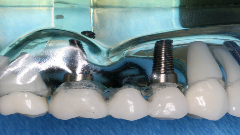 Are Teeth Implants Painful? Unveiling the Truth About Dental Implants