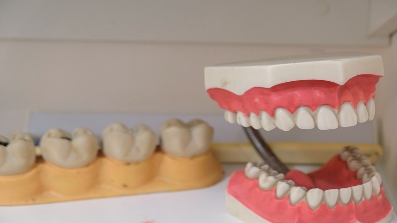 Are Cantilever Bridges the Solution for Your Missing Teeth?