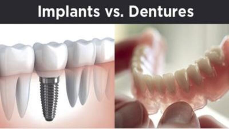 Dentures vs. Dental Implants: Choosing the Right Option for Your Needs
