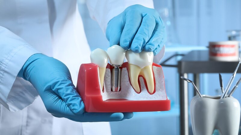 Dental Implant Concerns