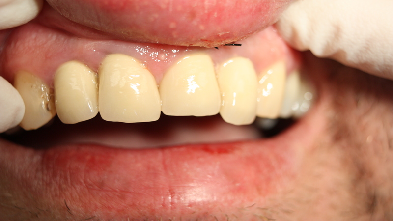 What Are Common Gum Problems and How to Fix Them?