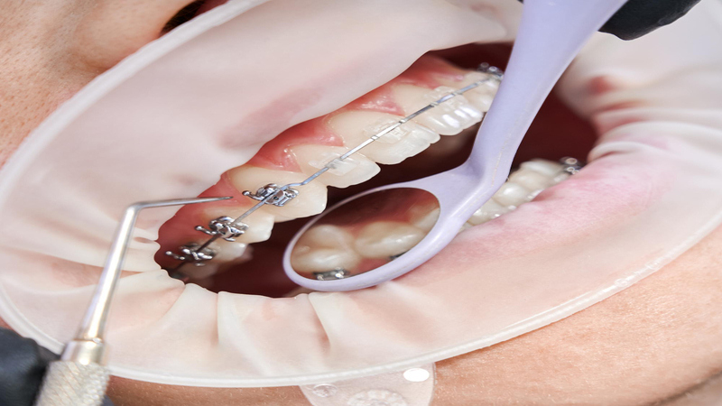 What is the procedure for getting dental braces?