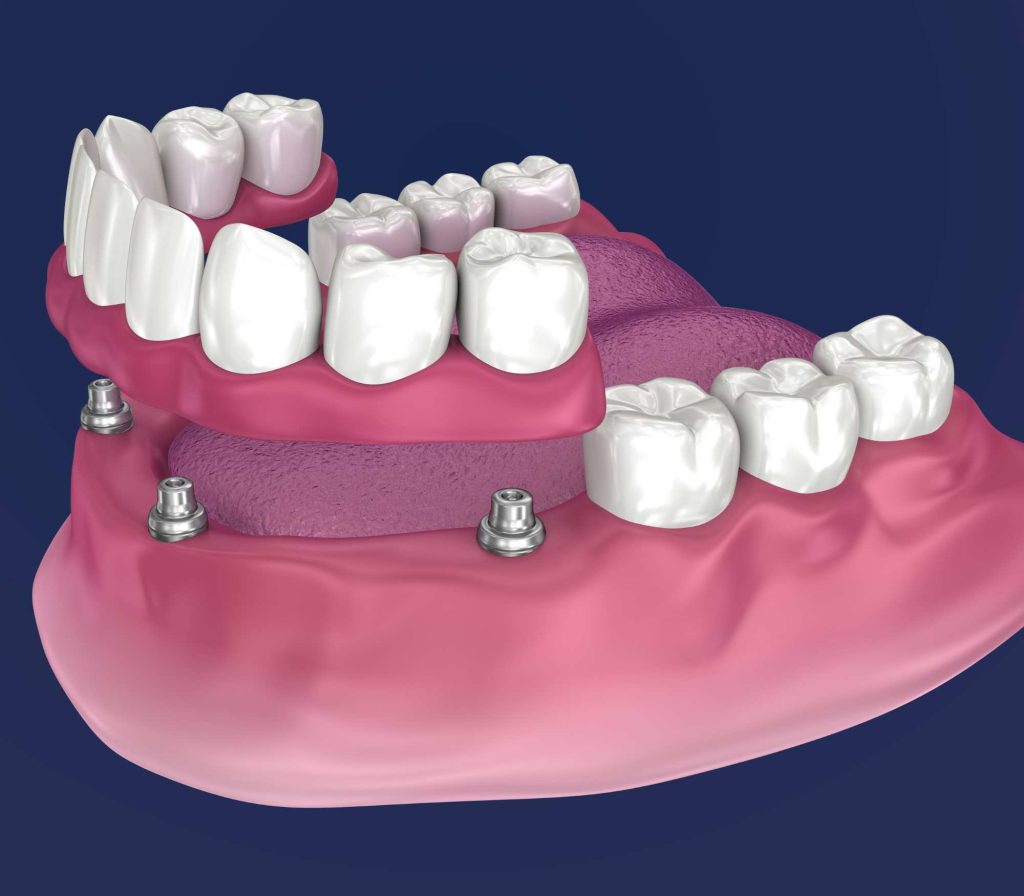 denture implant